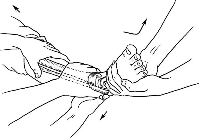骨折闭合复位髓内钉内固定术,骨折闭合复位
