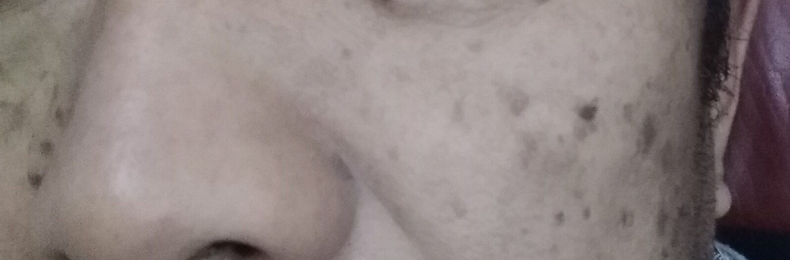 油溅到脸上有黑斑多久消失图片,40多岁脸上起黑斑是怎么回事