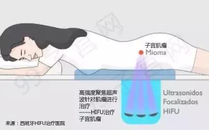 最靠谱的治疗子宫肌瘤,陈文直医生怎么样