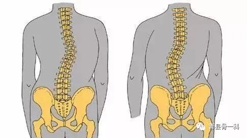 脊柱侧弯如何治疗才正确有效,先天性脊柱侧弯最好的恢复方法