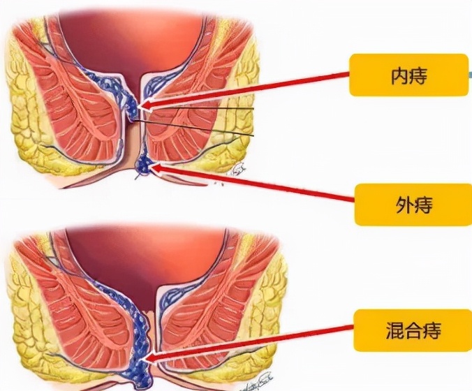 爬着走能治痔疮,睡前一招治痔疮