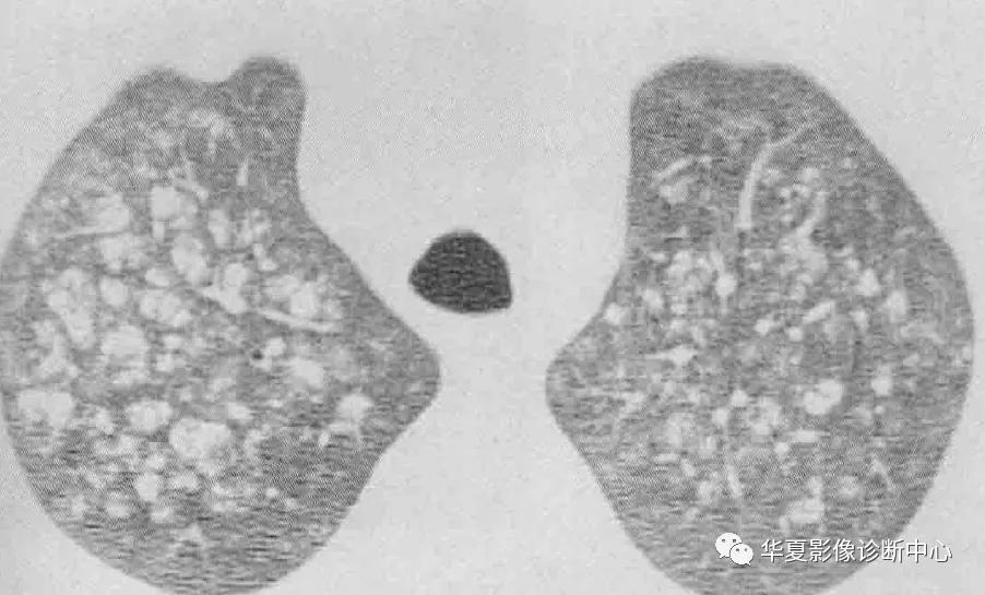 肺部代谢周期是多少天,肺部高代谢病变