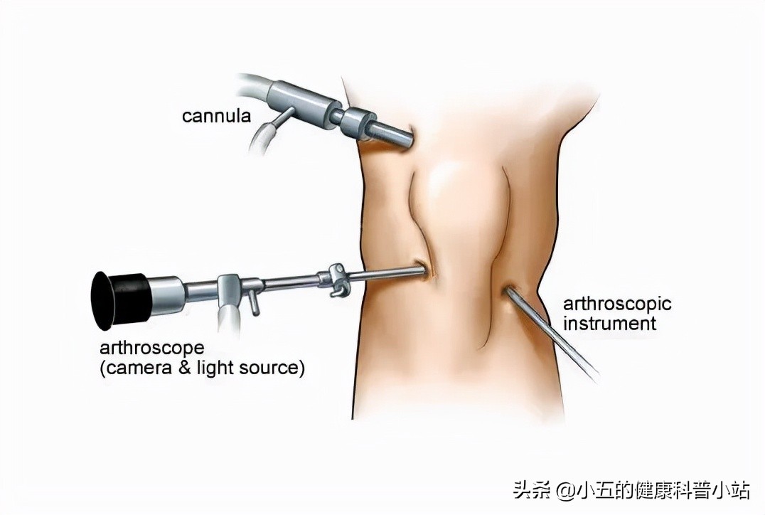 膝关节咔咔响发软是怎么回事,膝关节咔咔响乏力