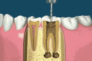 根管治疗和补牙哪个更贵,根管和补牙戴全瓷牙冠一共多少钱