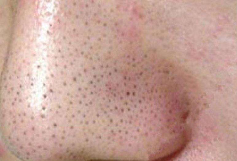 去黑头小妙招学生党草莓鼻,祛黑头3步轻松搞定顽固黑头