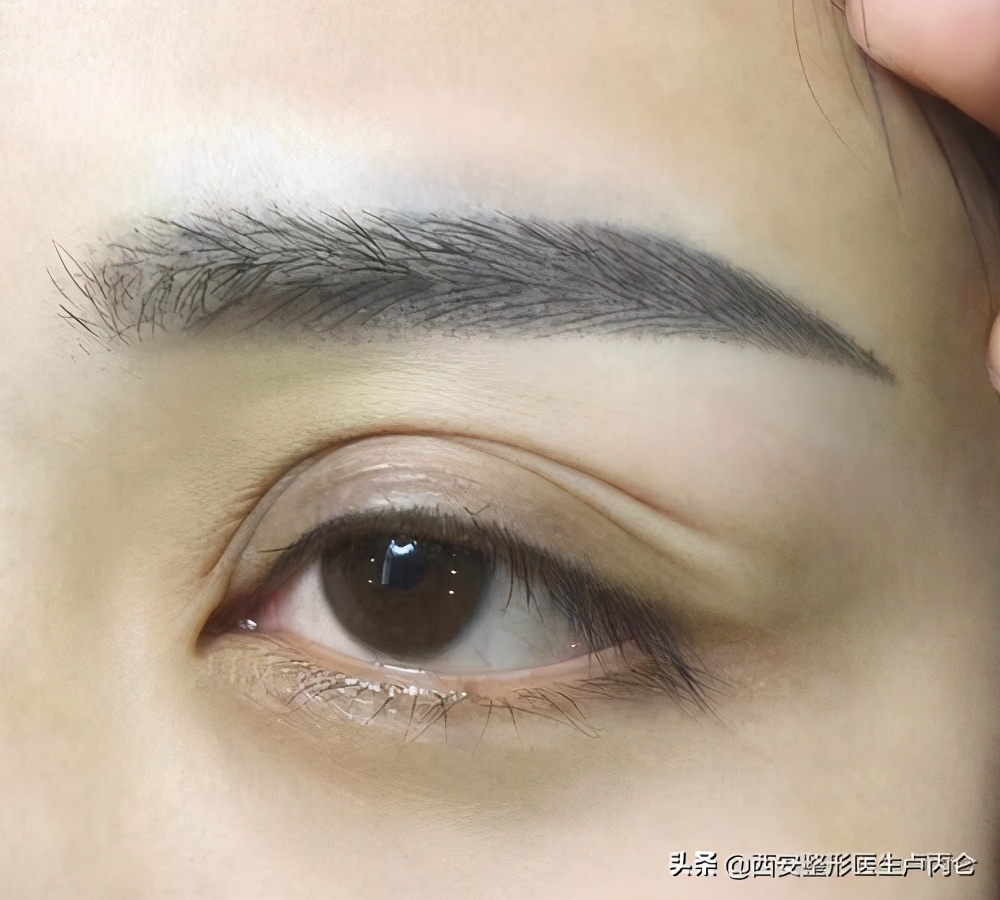 眉部吸脂,眉部解剖图
