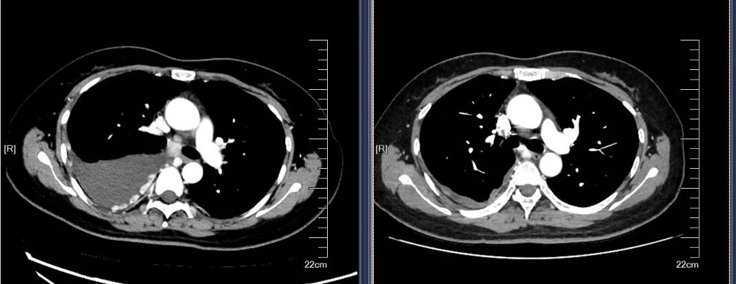宫颈癌免疫治疗病例分享,晚期宫颈腺癌病例分享