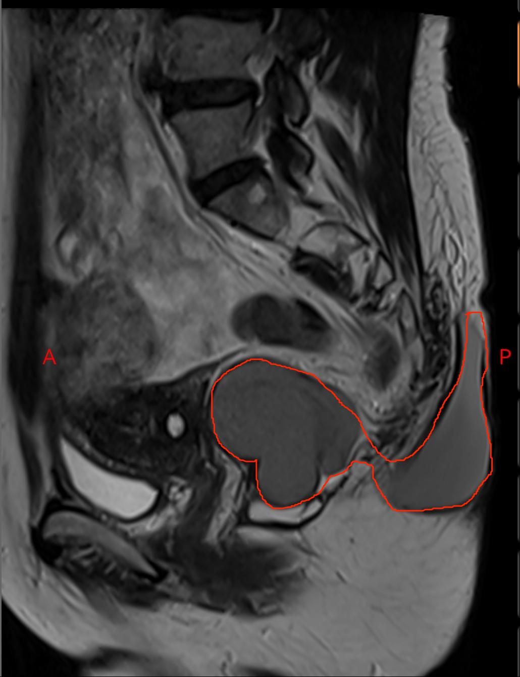 4cm的骶尾部囊肿,骶前发育性囊肿