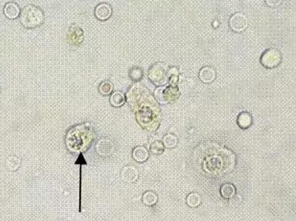上皮细胞3+什么意思,上皮细胞阳性