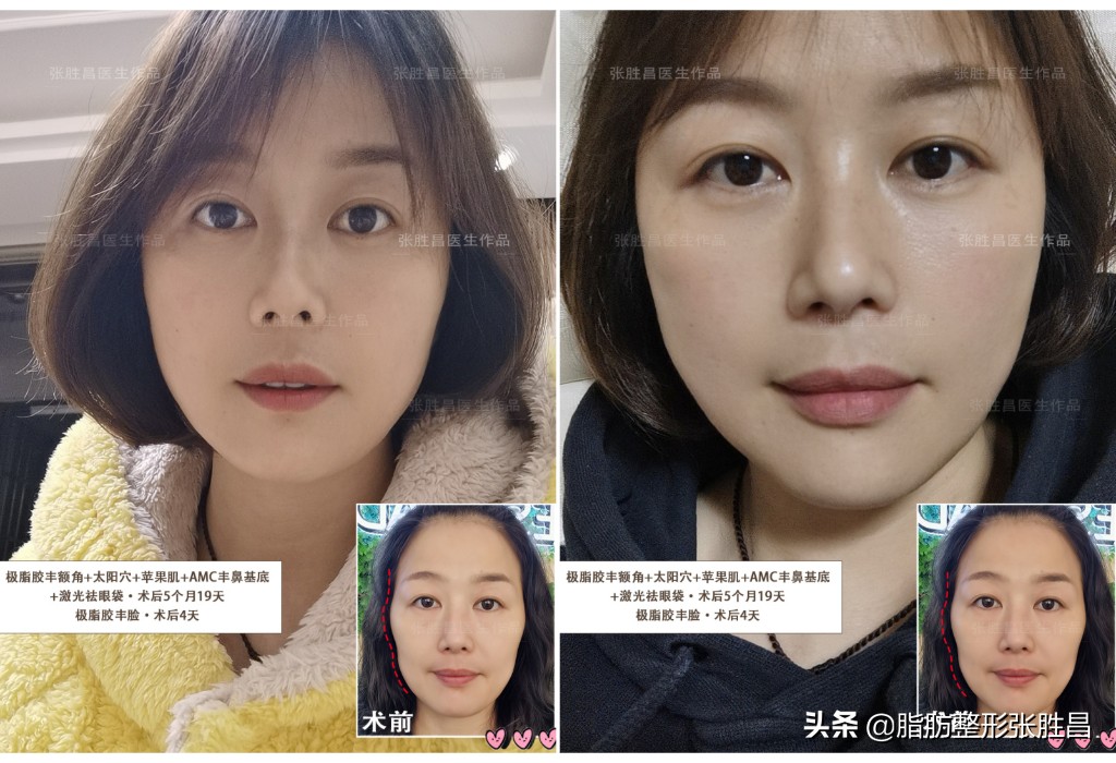 做脂肪填充面部以后变胖了,做脂肪面部填充会变美吗