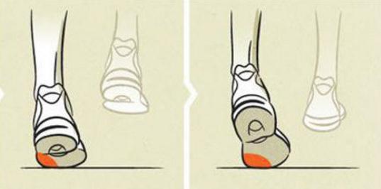 足内翻和踮脚走怎么康复,足内翻会导致什么腿型怎么改