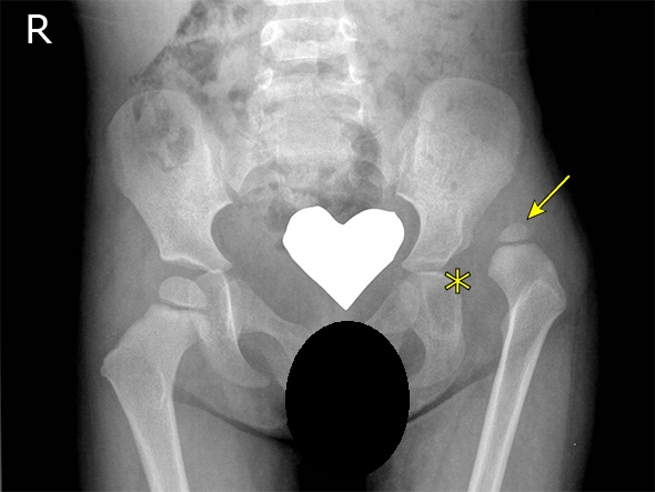 髋关节发育不良有什么拯救的方法,狗狗髋关节发育不良吃什么药