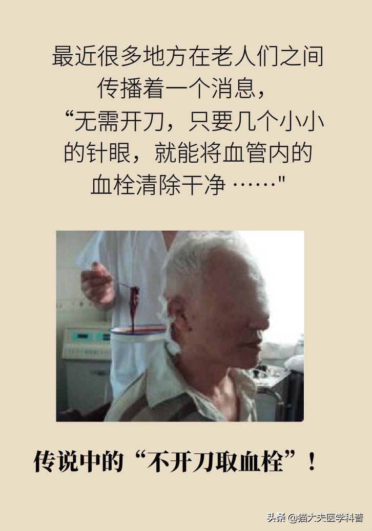 不手术能彻底治好血栓外痔吗,介入治血栓最好的方法