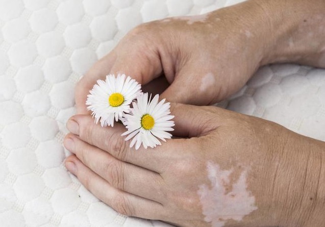 白癜风患者需要注意什么,白癜风患者要注意哪些事项