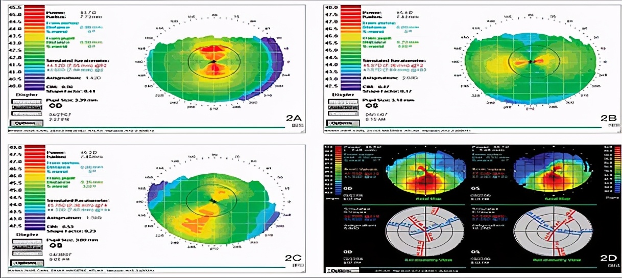 坤亮近视,坤亮散光恢复法