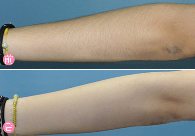 皮肤黑对脱毛效果有影响吗,脱毛后皮肤很黑怎么办