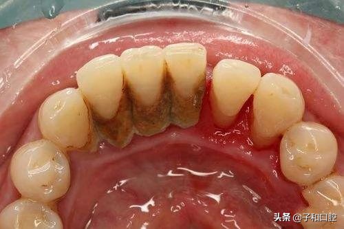 刷牙姿势不对牙龈有缝隙怎么补救,刷牙洗脸处好多苔藓