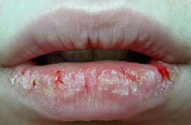 这个不到20块钱的润唇膏,居然可以治疗唇炎,尤其推荐干燥季节用