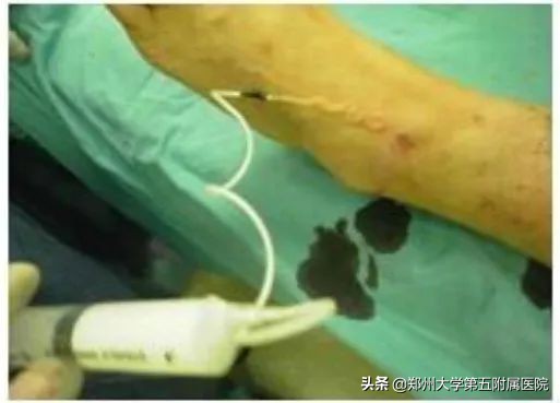 静脉曲张远离老烂腿,下肢静脉血管曲张怎么办