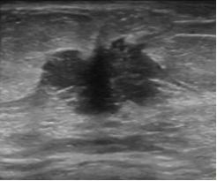 乳腺彩超报告中隐藏的秘密,乳腺结节4a怎么判断良性还是恶性