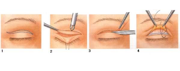 做完双眼皮为什么会有肉条感,做完双眼皮肉条感可以消除嘛