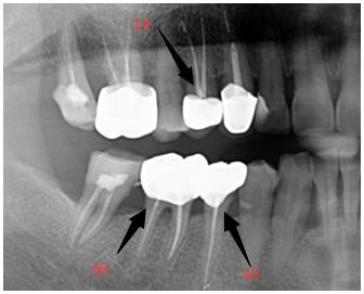 根管治疗后还不敢吃东西怎么办,根管治疗后能直接吃东西吗