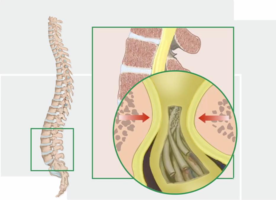 腰椎管狭窄了，手术好？还是不手术好？