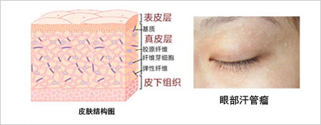 告别脂肪粒,告别脂肪粒的烦恼