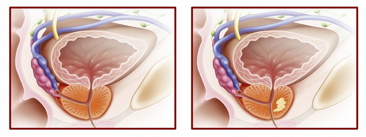 慢性细菌性前列腺炎反复尿路感染,慢性前列腺炎尿路反复感染咋治疗