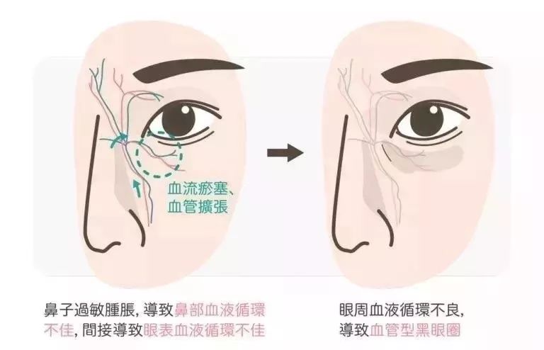 明明没有熬夜，黑眼圈就是去不掉？试试这个办法吧