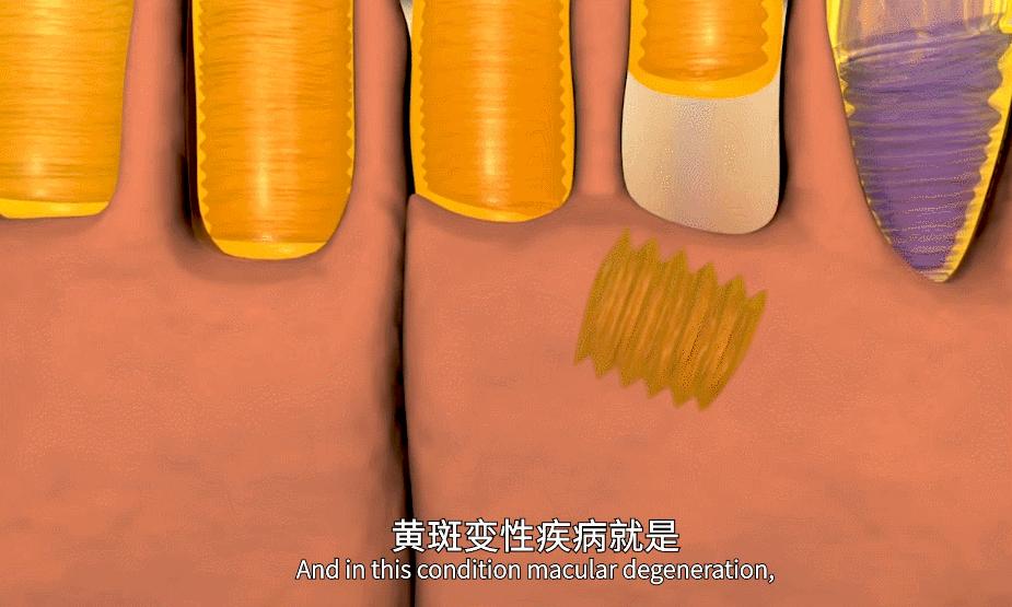 干细胞治疗黄斑变性者自述,黄斑变性失明的悲惨生活