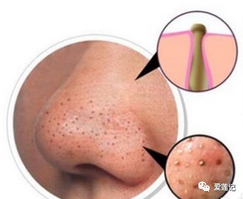 青春期黑头痘痘闭口毛孔粗大出油,油光满面毛孔粗大黑头闭口怎么办