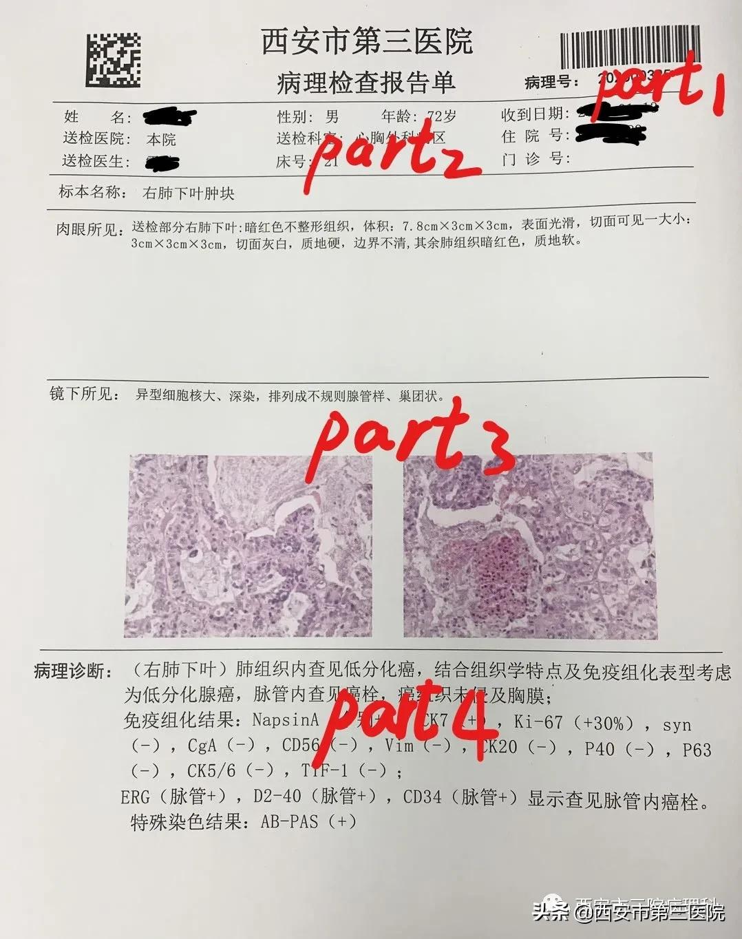 患者讲述肺癌症状,中医讲解肺癌早期的症状