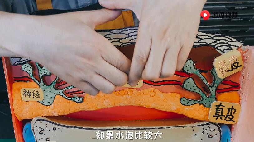 烫伤不小心把水泡戳破了怎么办,皮肤被烫伤起的水泡可以戳破吗