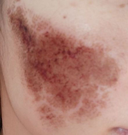 点阵激光能修复到什么程度,点阵激光凹陷疤痕能修复多少