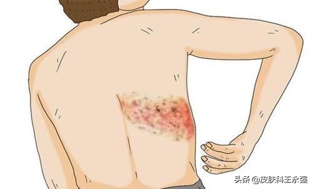 缠腰龙神经痛去医院挂什么科,缠腰龙疼得受不了怎么办