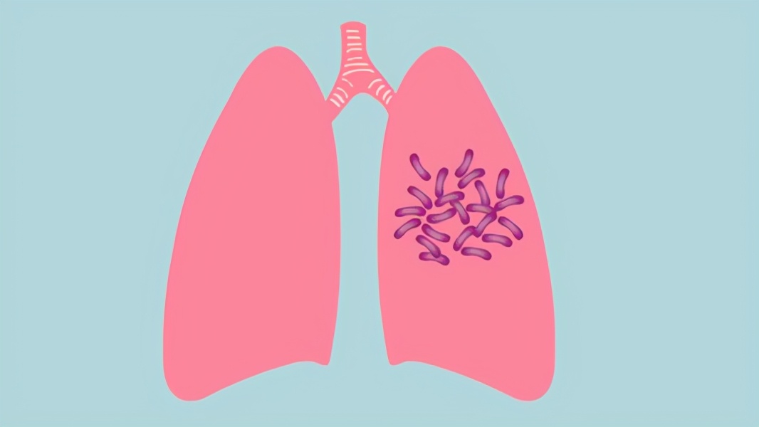 结核性胸膜炎有多严重,结核性胸膜炎治好的标准是什么