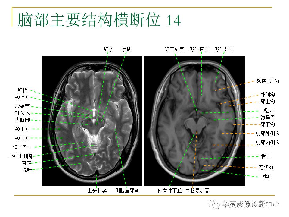 中国人脑立体定向mri应用解剖图谱,脑mri示意图