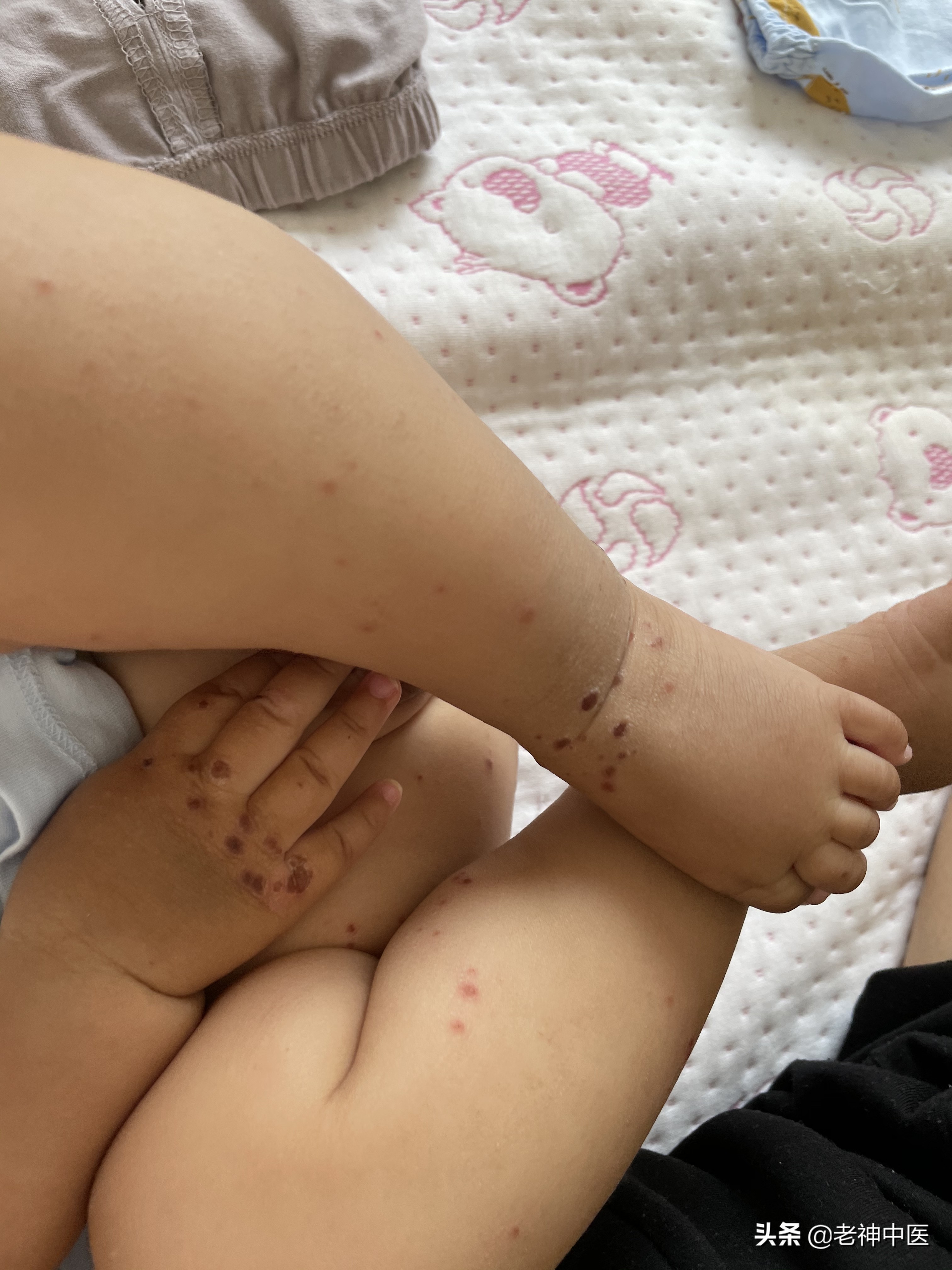 成人手足口病传染,儿童手足口病怎么传染的