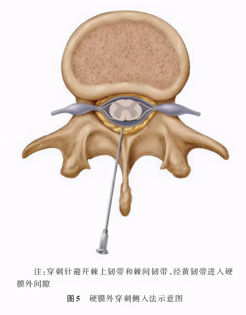 中国麻醉学2020版专家共识,硬膜外阻滞疗法