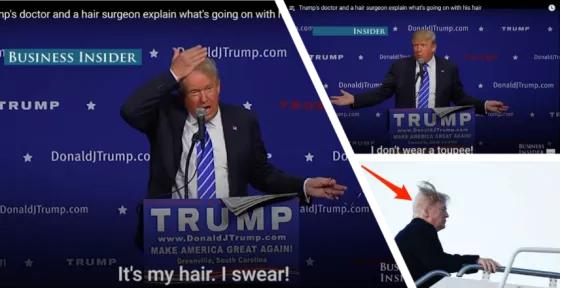 脱发治愈研究,困扰当代年轻人的脱发