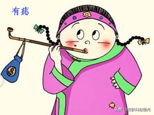 祛痣是用激光祛好还是药水好,冷冻祛痣和激光祛痣哪个更彻底