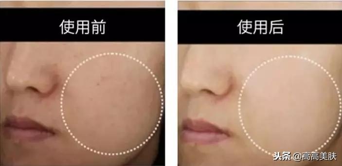 韩国东星制药美白祛斑霜,东星琅丝曲酸小黑瓶祛斑霜