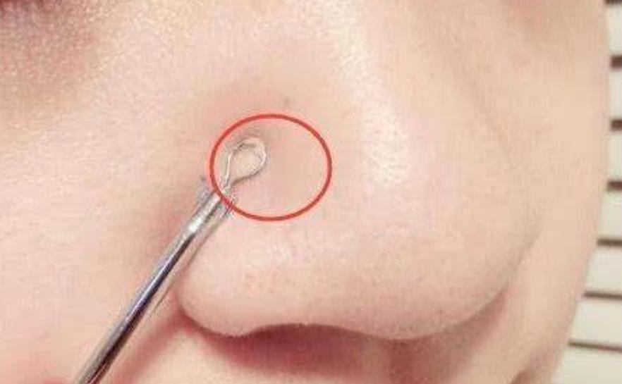 鼻子长黑头如何去除不花钱,鼻子老长黑头怎么办