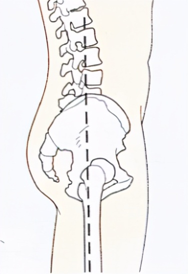 腰变直要怎样矫正,能让腰变直的几个动作