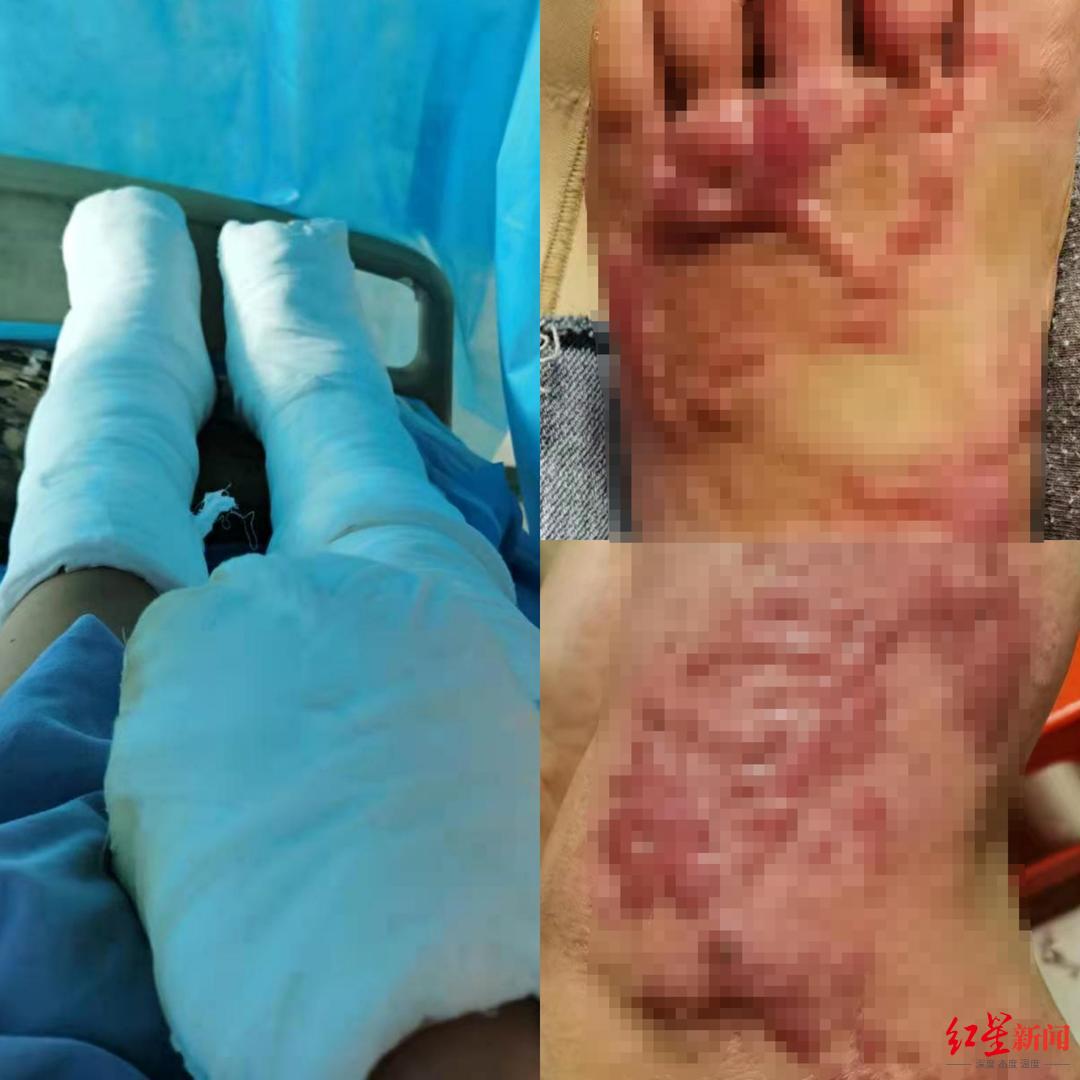 顾客斗殴致店主3人被烫伤,顾客打架致店主等3人被烫伤