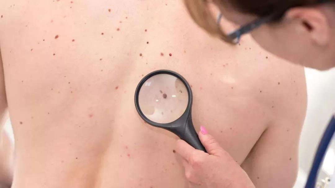 黑痣癌变这个痣是突然出现的么,黑痣凸起会诱发痣癌变是真的吗