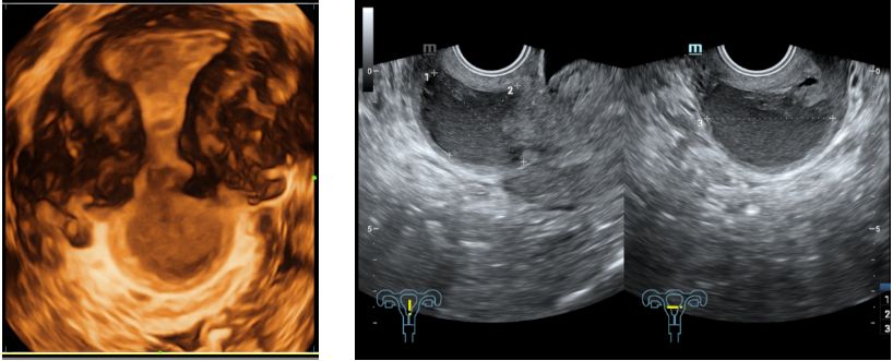 子宫疤痕憩室的思考,无症状子宫瘢痕憩室