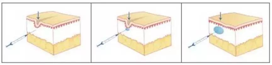 祛痘印最有效的方法,有什么祛痘印最有效的方法