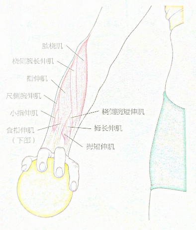 网友打羽球得网球肘用很多方法不见好，送他这套运动康复方案